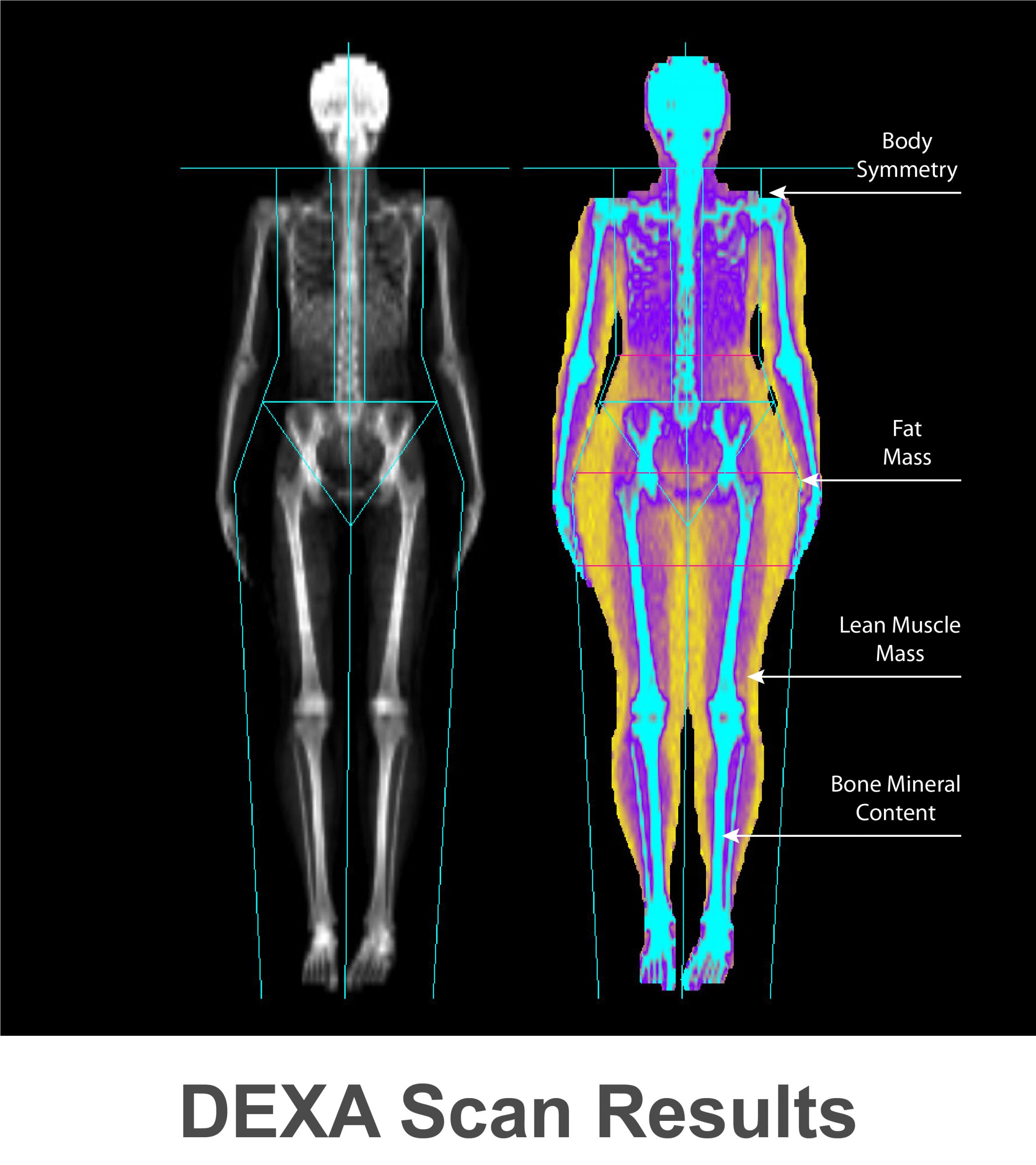 DEXA (DXA) Scan: Bone Density Test Accurate Imaging