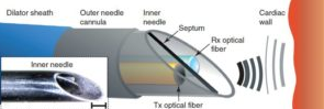 NEW ULTRASOUND TECHNOLOGY ON A NEEDLE IS ADVANCING SURGERY