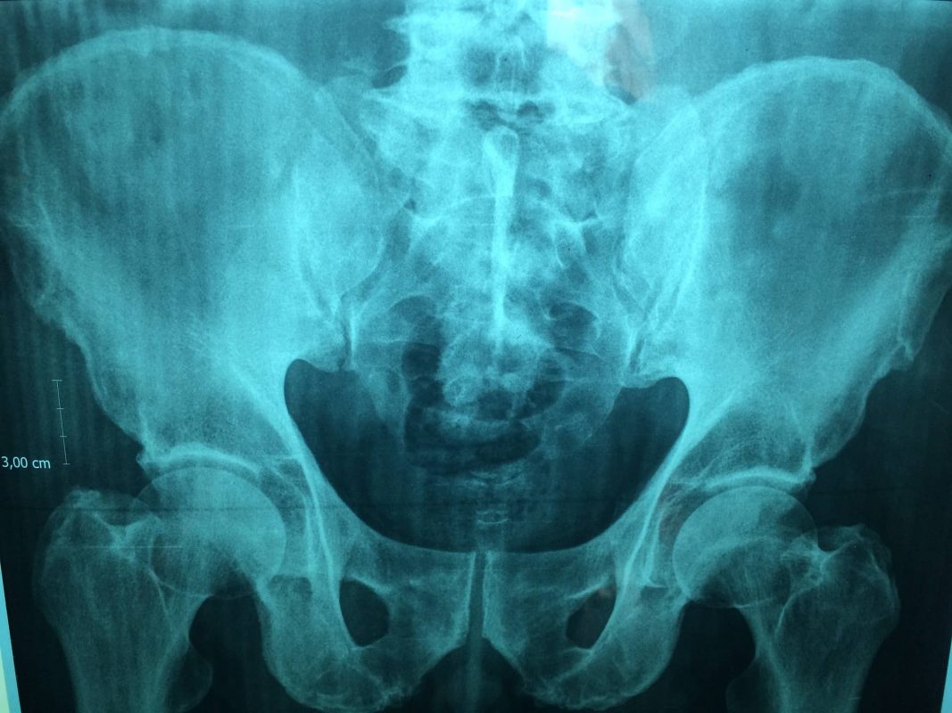 Bone Mineral Density Test Illustration